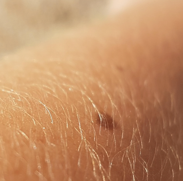 Cryotherapy for Mole & Skin Tag Removal - Image 2