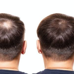 Biotin Injections for Hair Growth – Training Course