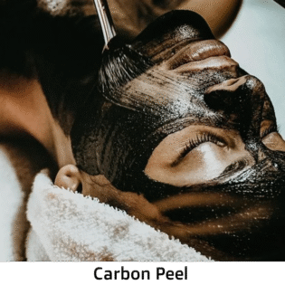 Carbon Laser Peel – The Ultimate Glow-Up