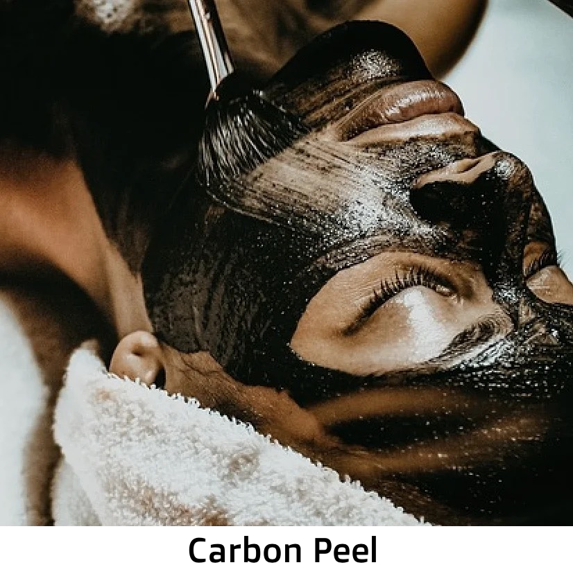 Carbon Laser Peel β The Ultimate Glow-Up