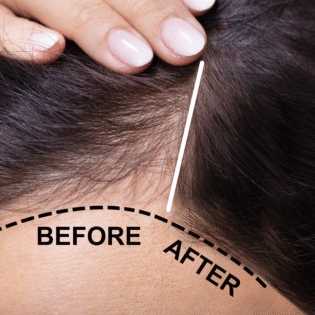 Polynucleotide Hair Regeneration Treatment – 4-Hour Training Course (CPD Certified)