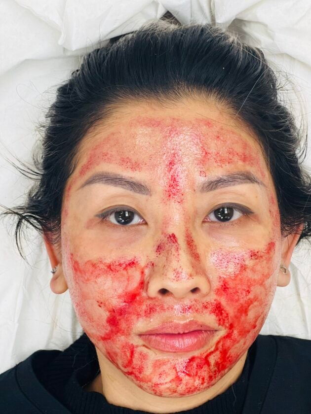 Microneedling Training Course (4 Hours) – CPD Accredited